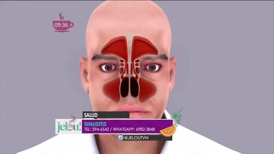 La Sinusitis. Tipos, síntomas y tratamiento.