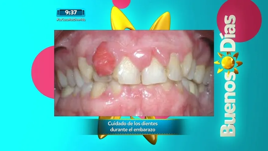 Un especialista nos hablará del cuidado de los dientes durante el embarazo