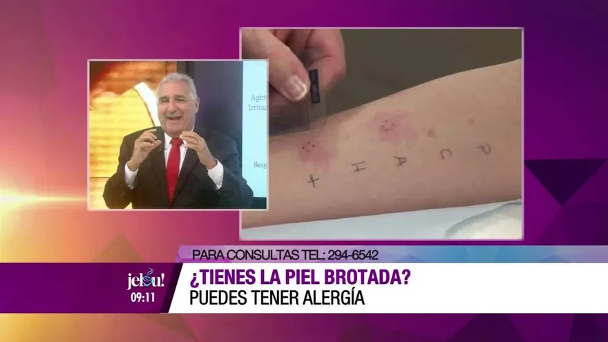 ¿Tienes la piel brotada? Puedes tener alergias