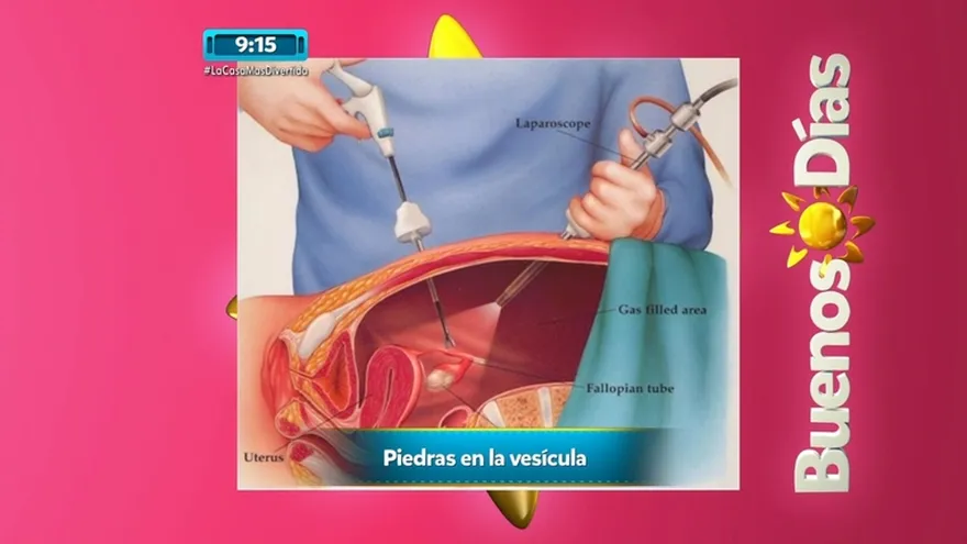 Sufres de dolor abdominal, fiebre, tal vez estás sufriendo de piedras en la vesícula