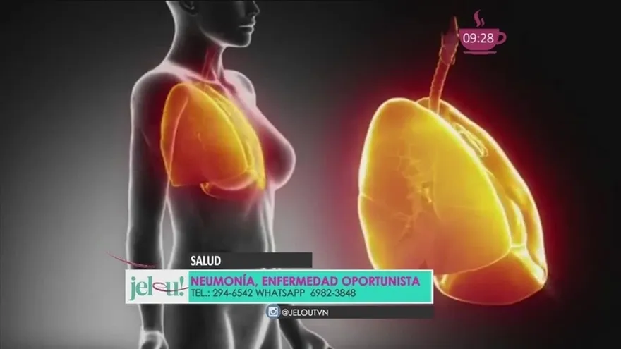 ¿Tienes un resfriado que no se te quita? Pudiera ser Neumonía ¡CUIDADO!