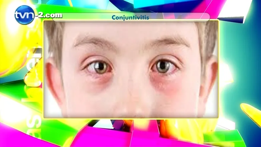 Madres al Rescate - La Conjuntivitis