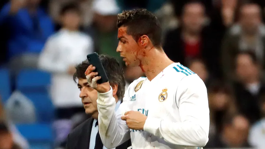 Cristiano se retiró con una brecha cerca del ojo izquierdo