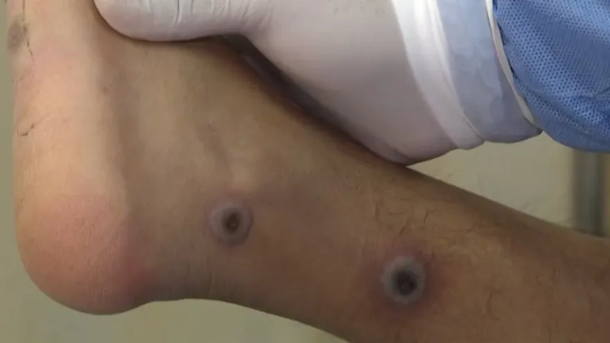 Autoridades de Panamá Oeste están vigilantes ante alerta de viruela de mono