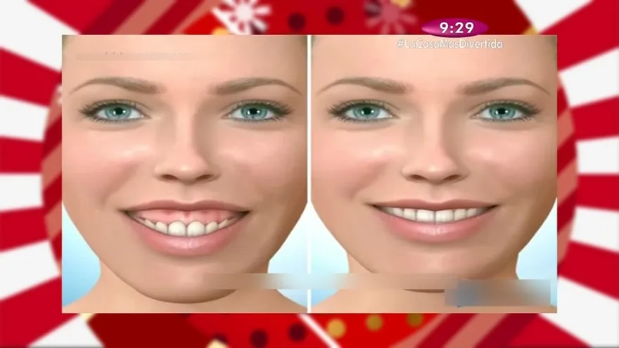 Salud Dental - Sonrisa gingival cómo podemos solucionar ese problema