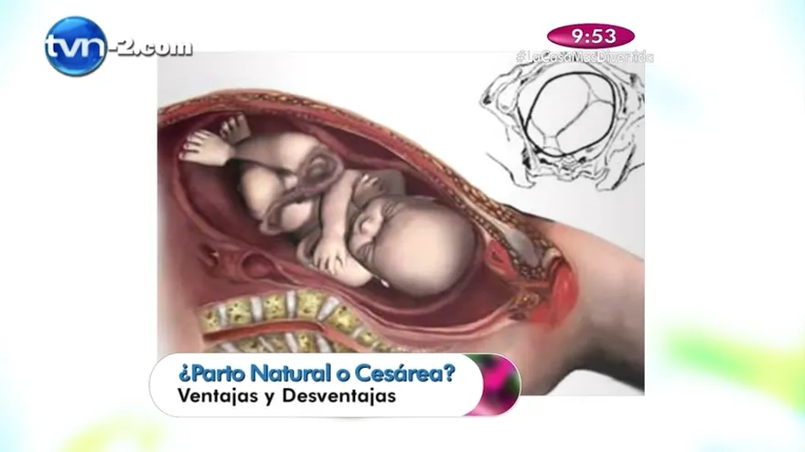 Salud al día - Parto Natural o Cesárea , Ventajas y Desventajas