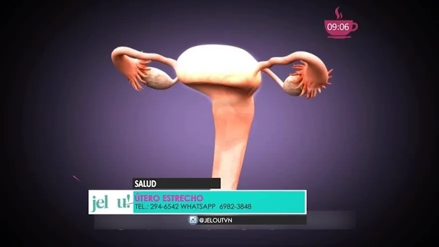 Te diagnosticaron "Útero Estrecho" y no sabes qué es. Aquí te explicamos eso y más