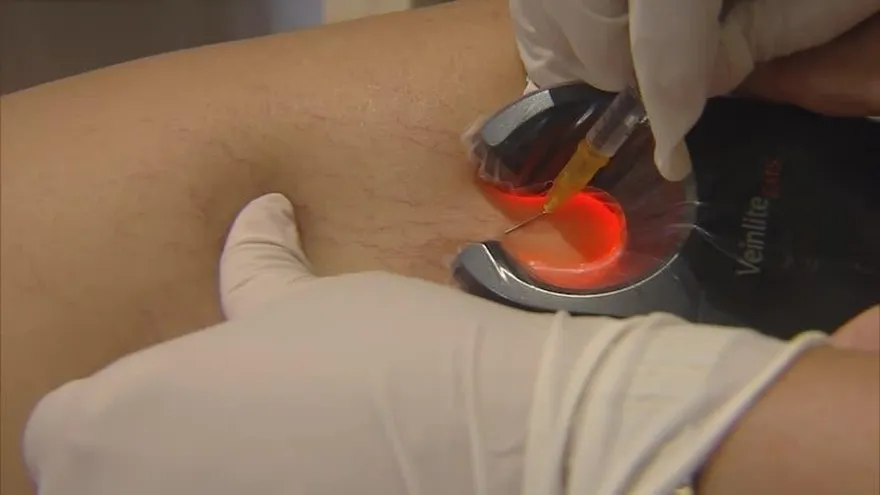 ¡Esas várices en las piernas no las soporto! No te preocupes que hay solución