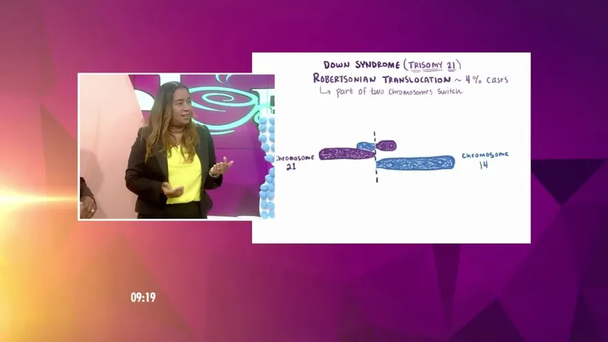 ¿Qué es el síndrome de Down y cuáles son sus causas?
