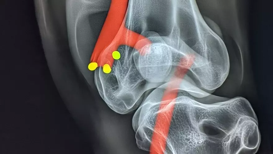 Imagen ilustrativa lesión de ligamento cruzado