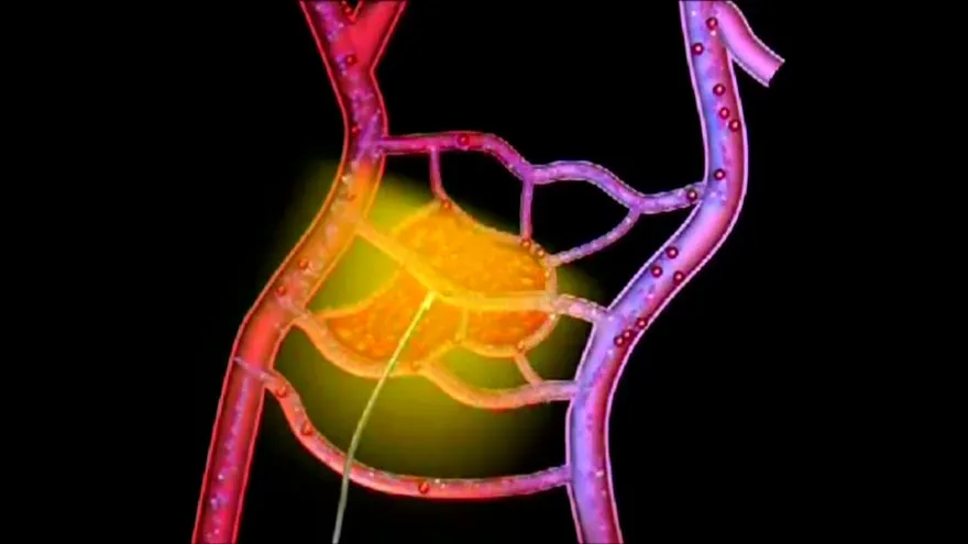 Cáncer de próstata afecta a muchas jóvenes en Panamá