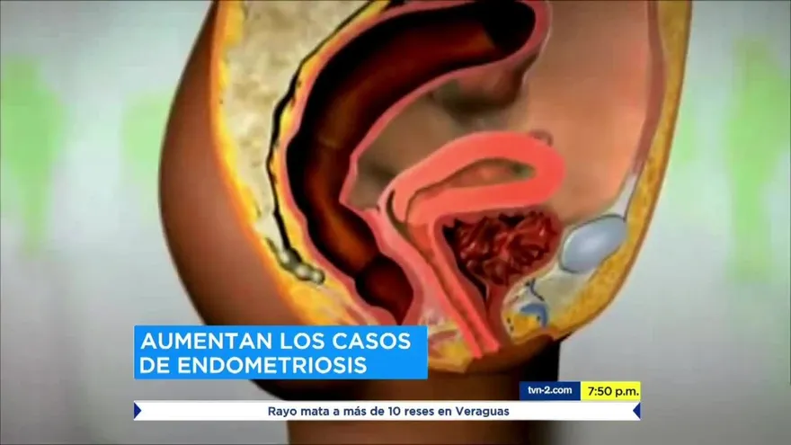 Una de cada diez mujeres sufre de endometriosis