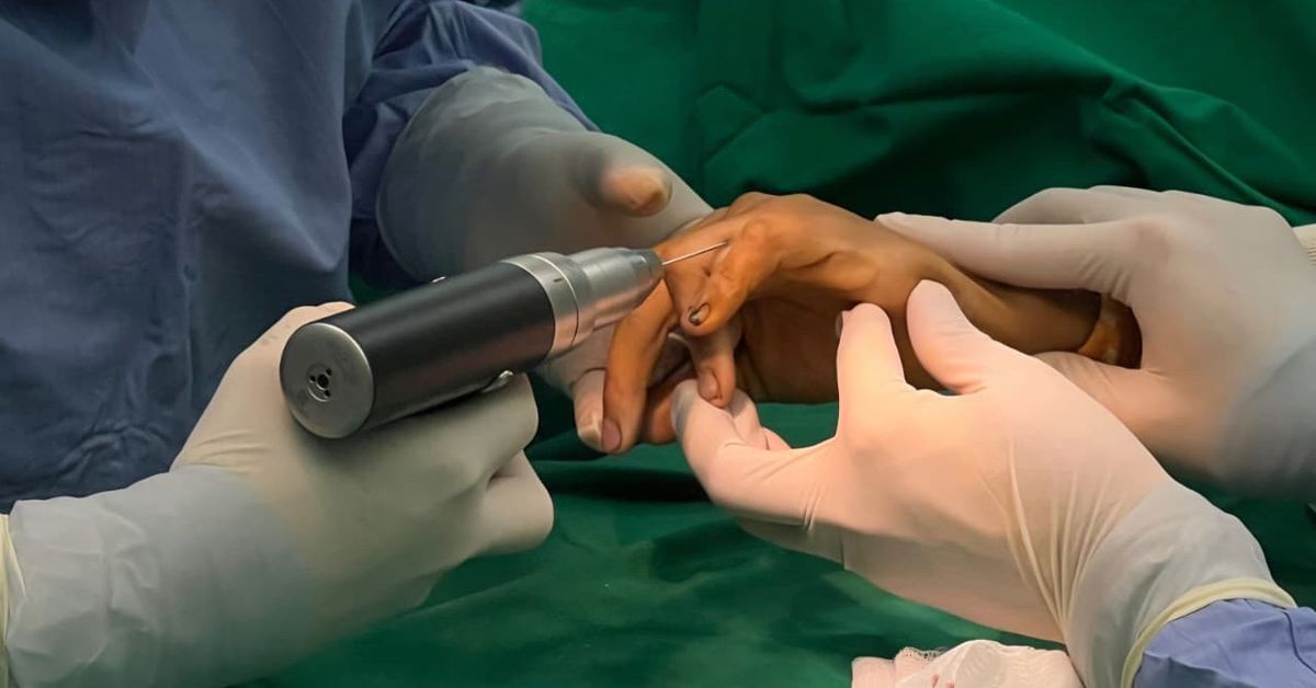 CSS realiza primera osteotomía rotacional de alta complejidad en Veraguas