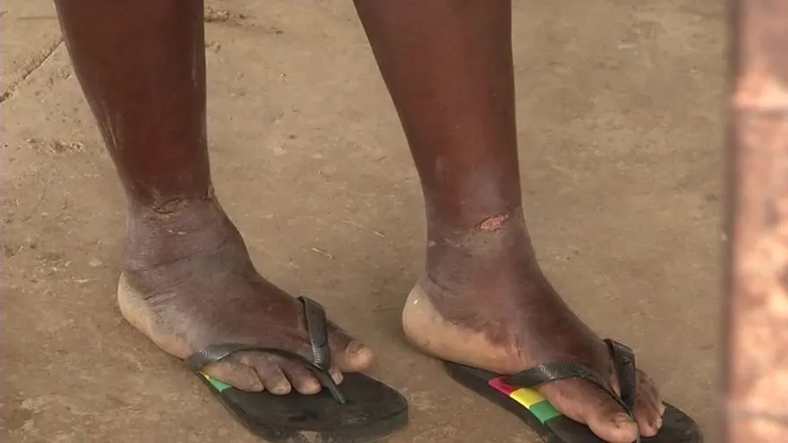 Riesgo sanitario por entrada de migrantes