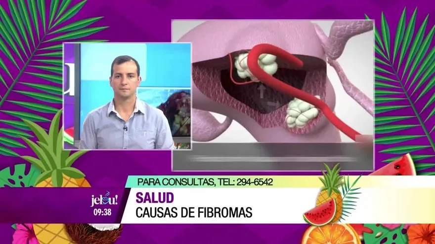 ¿Qué causan los fibromas?