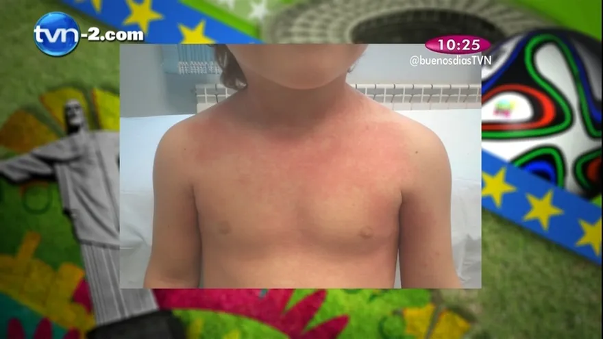 Segmento Madres al Rescate -  ¿Tu bebé padece de sarpullido?