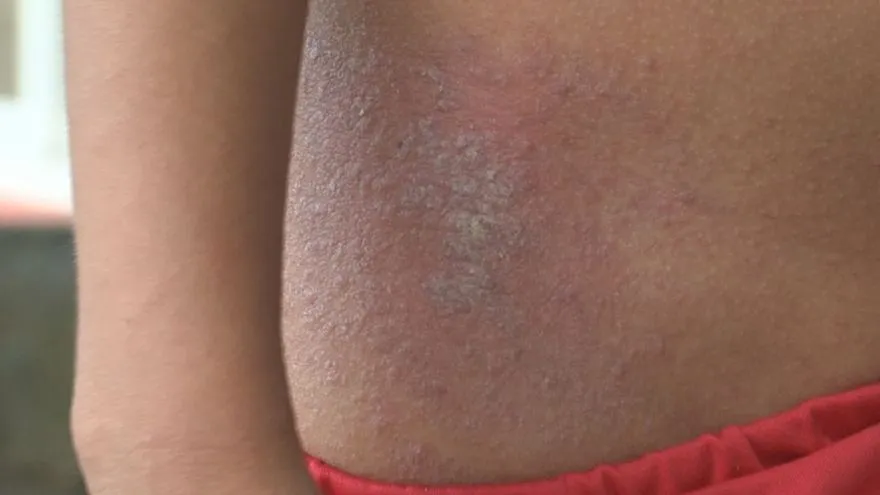 Panamá acoge encuentro sobre enfermedades de la piel con foco en diagnóstico y acceso