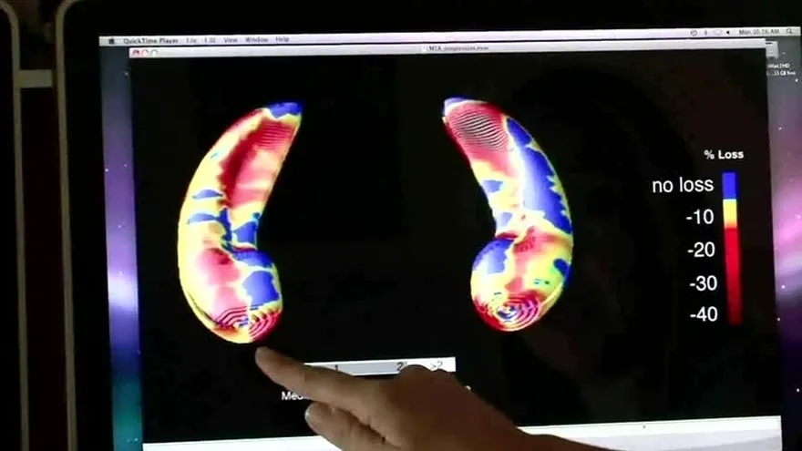 El alzheimer es más frecuente en Panamá