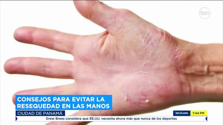 Consejos para evitar la resequedad en las manos