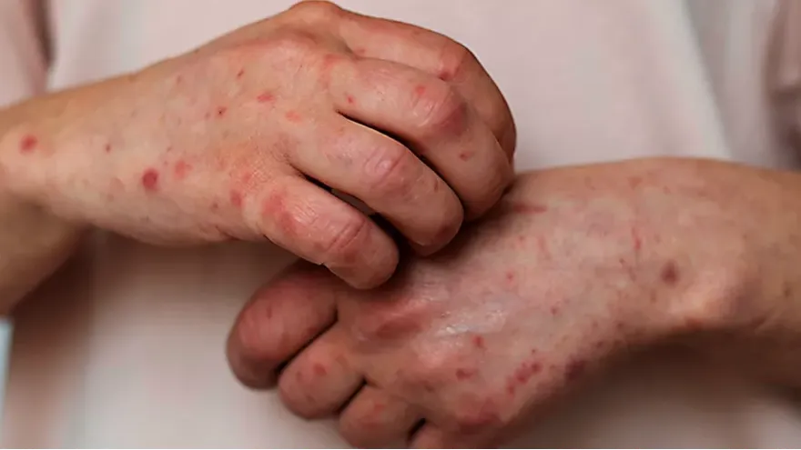 Casos importados de sarampión mantienen en alerta al sistema de salud