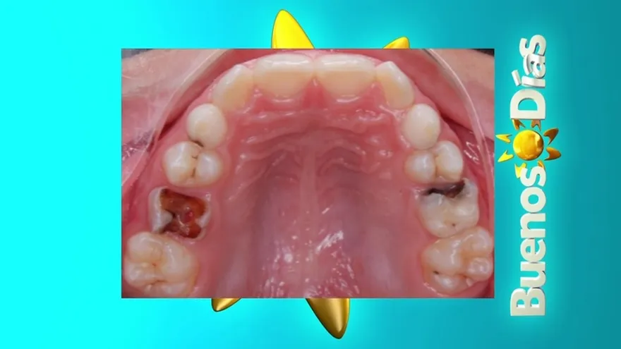 Porqué  no debemos dejar que nuestros hijos se duerman con el biberón en la boca