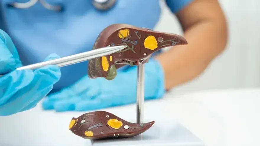 En Panamá se regsitran al año cerca de 300 casos de cáncer de hígado