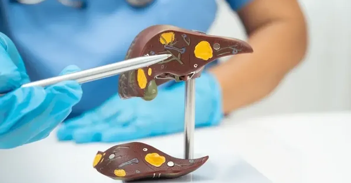 Cáncer de hígado: advierten sobre alta mortalidad y la importancia de la detección temprana