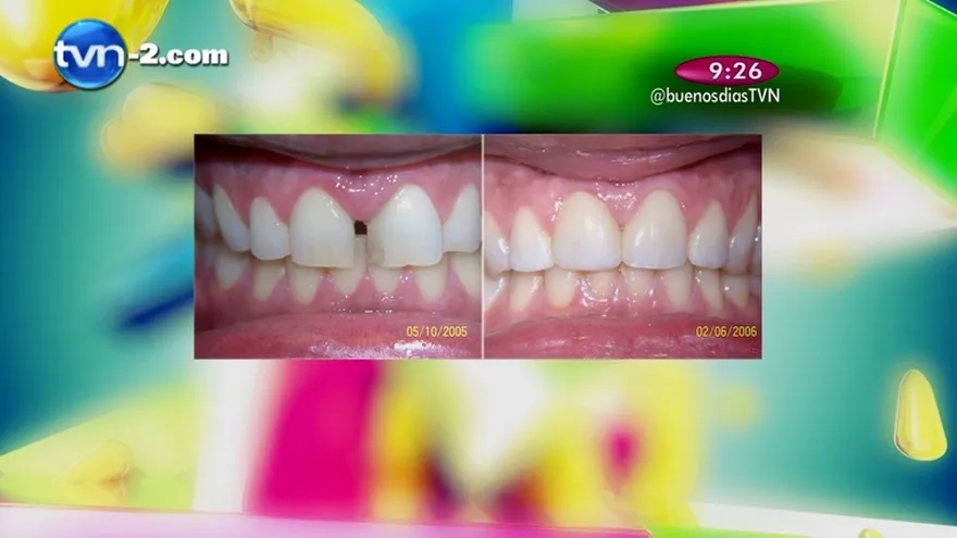Segmento Salud Dental - Dientes separados ¿Cómo podemos solucionar este problema
