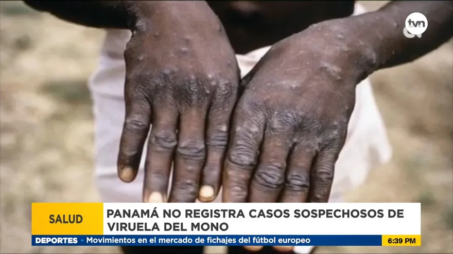 Panamá no presenta ningún caso de viruela de mono
