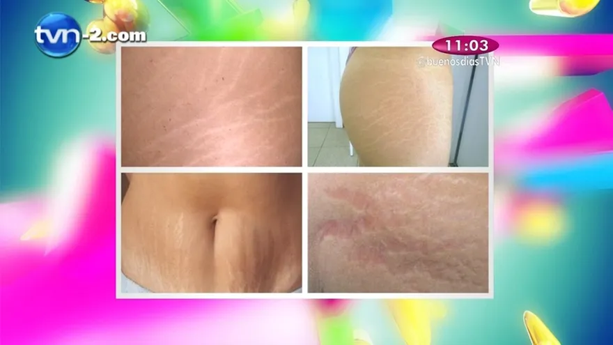 El Yerbatero - Remedios para las Estrías