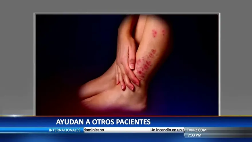 La crueldad de la psoriasis
