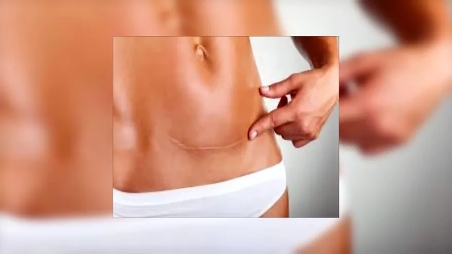 Dile adiós a las Cicatrices