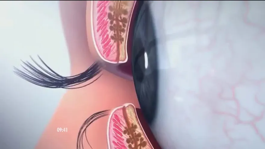 Descubre como puedes evitar el contagio de conjuntivitis