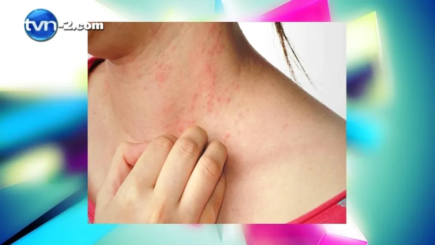 Yerbatero - Remedios para las Alergias