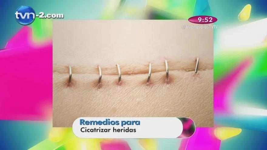 Remedios Para cicatrizar heridas