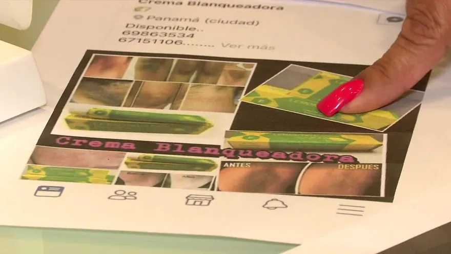 Decenas sufren quemaduras por crema dermatológica en las últimas semanas.