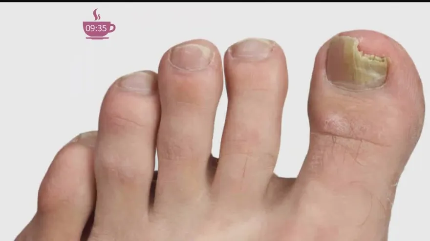 ¿Tienes hongos en los pies? En la clínica "Pie Salud" nos enseñan cómo eliminarlos