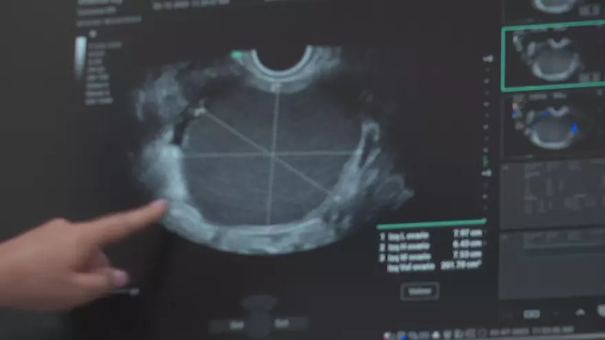 Exámenes de una paciente con endometriosis