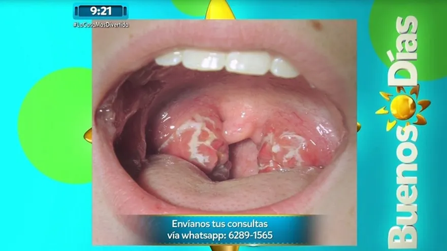 Síntomas para identificar si puedes estar sufriendo de amigdalitis