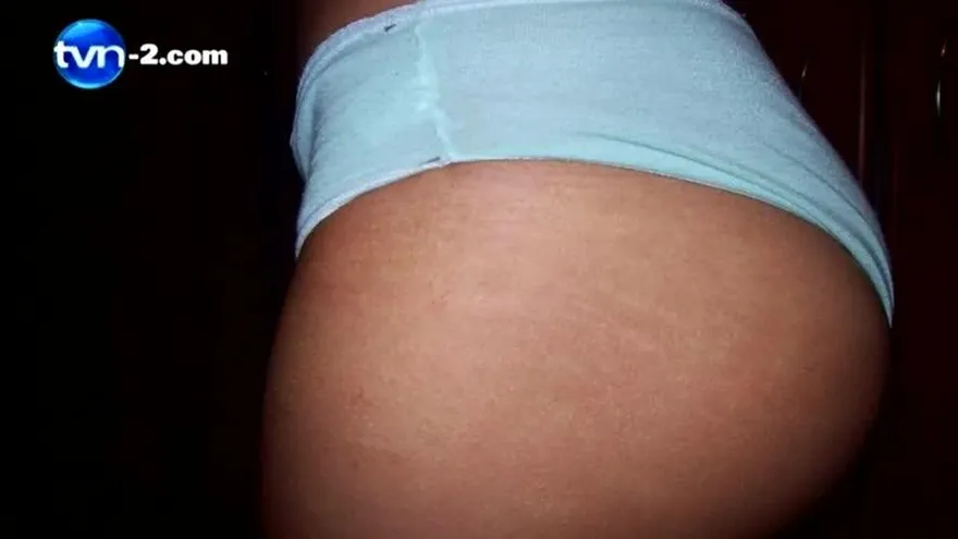 PIEL LIBRE DE ESTRÍAS