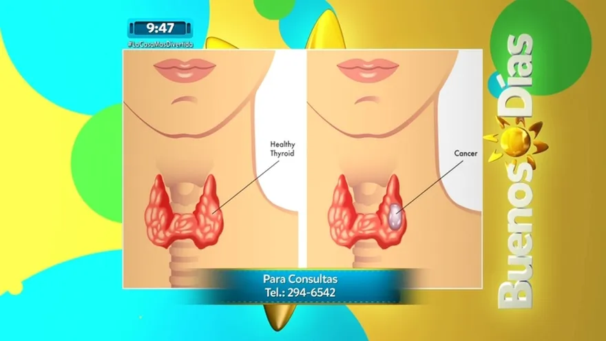 Las Tiroides