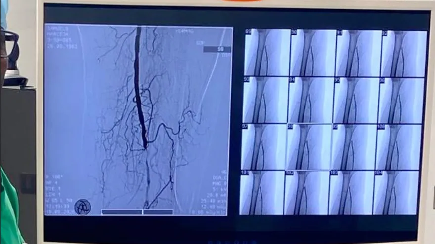 El procedimiento innovador se realizó en el nuevo Hospital Dr. Manuel Amador Guerrero