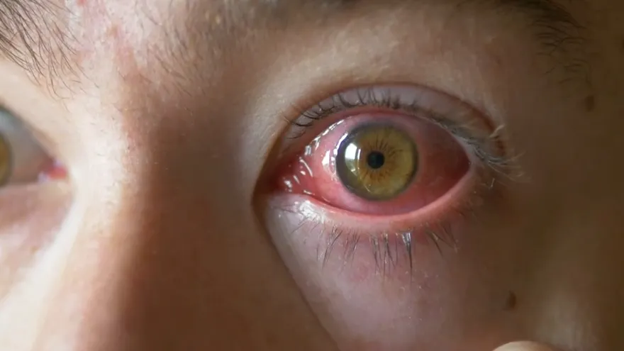 Circulan cuadros de conjuntivitis viral