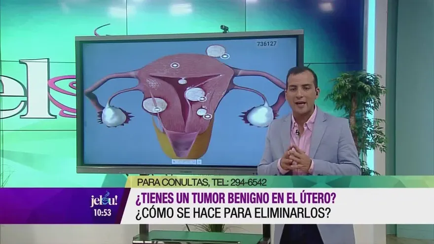¿Tienes un tumor benigno en el útero?