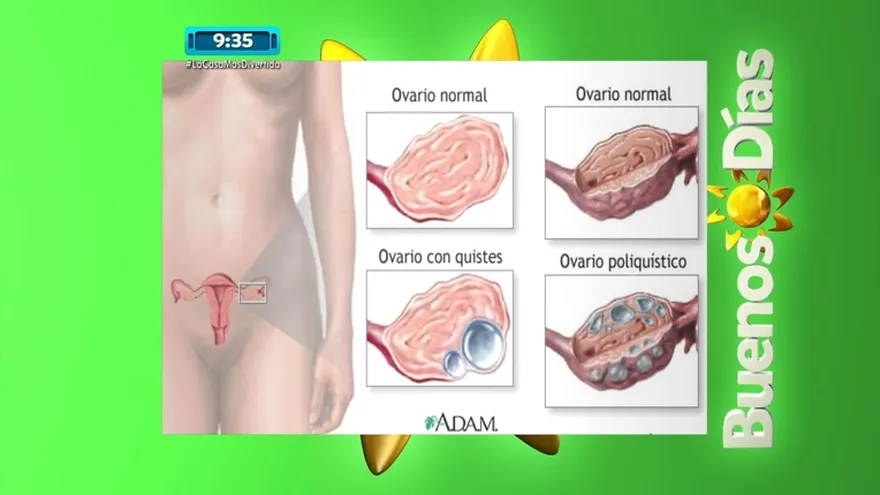 Sufres de hinchazón y dolor en el vientre, sangrado abundante tal vez estés sufriendo de Quistes en los ovarios