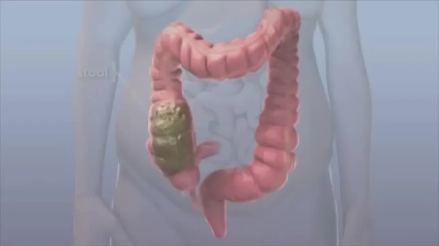 Años de padecer Estreñimiento ¿Cómo soluciono este problema?