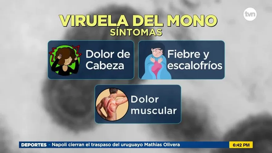 Los síntomas de la Viruela del mono