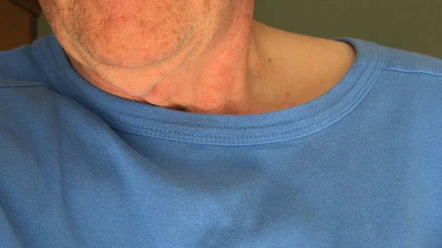 Los pacientes que tienen herpes zóster pueden correr un riesgo mayor a sufrir un ataque al corazón o un accidente vascular cerebral.