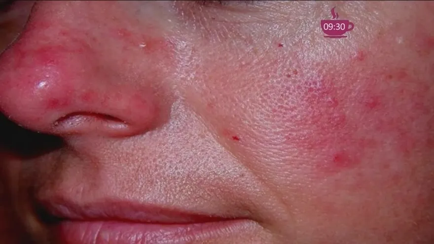 ¿Qué hacer con la piel rosácea?