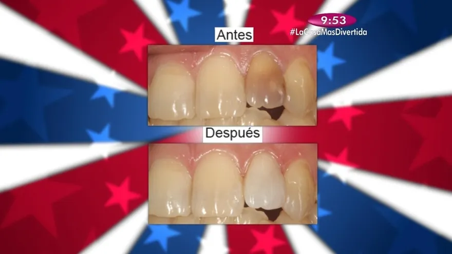 Salud Dental - Blanqueamiento sobre dientes con trabajo de endodoncia